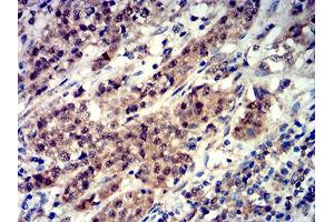 Immunohistochemical analysis of paraffin-embedded bladder cancer tissues using Phospho-4E-BP1 (Ser65) mouse mAb with DAB staining. (eIF4EBP1 anticorps  (pSer65))