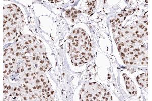 ABIN6268903 at 1/200 staining human Breast cancer tissue sections by IHC-P.
