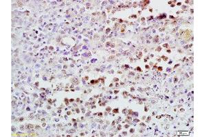 Formalin-fixed and paraffin embedded mouse lymphoma tissue labeled with Anti-CDK4 Polyclonal Antibody , Unconjugated at 1:300, followed by conjugation to the secondary antibody and DAB staining