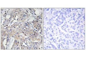 Immunohistochemistry analysis of paraffin-embedded human breast carcinoma tissue using COL6A3 antibody.