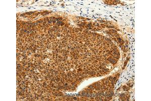 Immunohistochemistry of Human lung cancer using TRPC6 Polyclonal Antibody at dilution of 1:50 (TRPC6 anticorps)