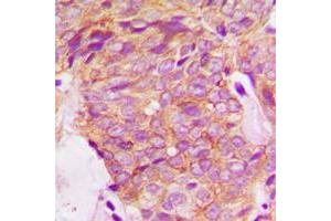 Immunohistochemical analysis of GRB14 staining in human breast cancer formalin fixed paraffin embedded tissue section.