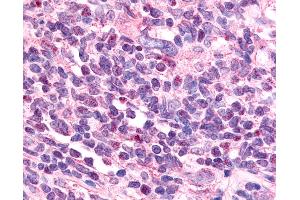 Anti-EAR2 / NR2F6 antibody IHC of human Lymph Node, Non-Hodgkins Lymphoma.