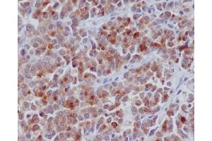 Immunohistochemical analysis of paraffin-embedded human colon cancer, using Cyclin B1 Antibody.