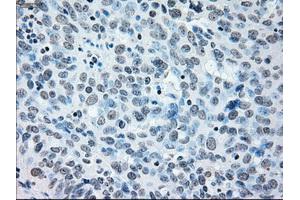 Immunohistochemical staining of paraffin-embedded Adenocarcinoma of colon tissue using anti-IRF3mouse monoclonal antibody. (IRF3 anticorps)