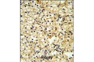TRAP Antibody IHC analysis in formalin fixed and paraffin embedded kidney carcinoma followed by peroxidase conjugation of the secondary antibody and DAB staining. (CD40 Ligand anticorps  (C-Term))
