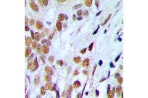 Immunohistochemical analysis of Lupus La (pS366) staining in human prostate cancer formalin fixed paraffin embedded tissue section. (Lupus La (C-Term), (pSer366) anticorps)