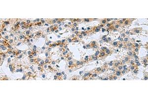 Immunohistochemistry of paraffin-embedded Human liver cancer tissue using GHRHR Polyclonal Antibody at dilution of 1:40(x200) (GHRHR anticorps)