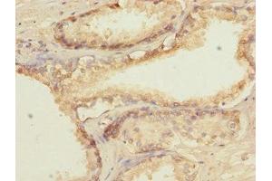 Immunohistochemistry of paraffin-embedded human prostate cancer using ABIN7172660 at dilution of 1:100 (GTF2A2 anticorps  (AA 1-109))
