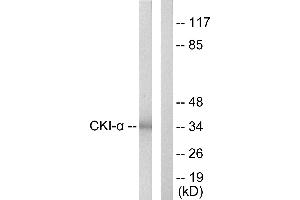 Immunohistochemistry analysis of paraffin-embedded human lung carcinoma tissue using CKI-α antibody. (CSNK1A1 anticorps)