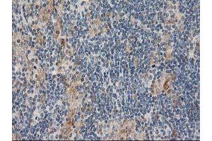 Immunohistochemical staining of paraffin-embedded Human lymphoma tissue using anti-CXorf26 mouse monoclonal antibody. (CXorf26 anticorps)