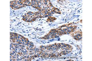Immunohistochemistry of Human esophagus cancer using AQP8 Polyclonal Antibody at dilution of 1:75 (Aquaporin 8 anticorps)