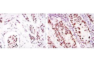 Immunohistochemical analysis of paraffin-embedded breast cancer (left) and colon cancer (right) using PRKDC mouse mAb with DAB staining.