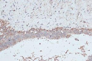 Immunohistochemistry of paraffin-embedded human breast cancer using MAP1LC3B antibody. (LC3B anticorps)