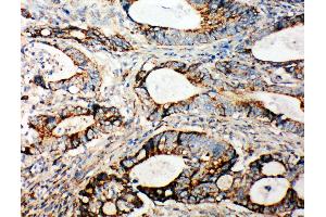 Anti-Integrin alpha 3 antibody,  IHC(P) IHC(P): Human Intestinal Cancer Tissue (ITGA3 anticorps  (N-Term))