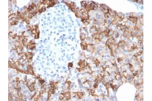 Formalin-fixed, paraffin-embedded human Pancreatic Carcinoma stained with TACSTD2 / TROP2 Mouse Monoclonal Antibody (TACSTD2/2152). (TACSTD2 anticorps  (AA 31-274))