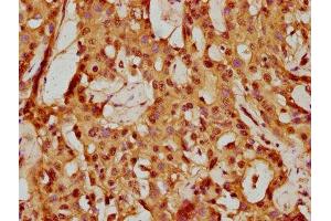 IHC image of ABIN7145298 diluted at 1:150 and staining in paraffin-embedded human liver cancer performed on a Leica BondTM system.
