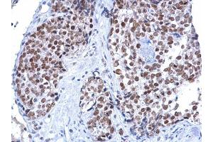 IHC-P Image Rad54 antibody [C3], C-term detects Rad54 protein at nucleus on human breast carcinoma by immunohistochemical analysis.