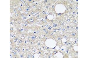 Immunohistochemistry of paraffin-embedded Human liver cancer using AFP Monoclonal Antibody at dilution of 1:12.