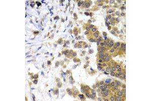 Immunohistochemistry of paraffin-embedded human breast cancer using Neurofilament L antibody (ABIN3020808, ABIN3020809, ABIN3020810 and ABIN6213733) at dilution of 1:200 (40x lens). (NEFL anticorps  (AA 400-543))