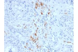 Formalin-fixed, paraffin-embedded human Testicular Carcinoma stained with StAR Mouse Monoclonal Antibody (STAR/2140).