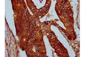 IHC image of ABIN7169703 diluted at 1:400 and staining in paraffin-embedded human colon cancer performed on a Leica BondTM system.