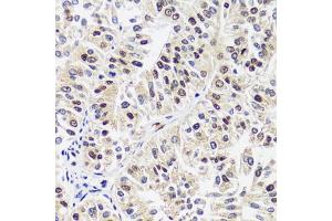 Immunohistochemistry of paraffin-embedded human uterine cancer using C antibody (ABIN7266546) at dilution of 1:100 (40x lens). (CAND1 anticorps  (AA 750-980))