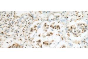 Immunohistochemistry of paraffin-embedded Human breast cancer tissue using SEPHS1 Polyclonal Antibody at dilution of 1:80(x200) (SEPHS1 anticorps)