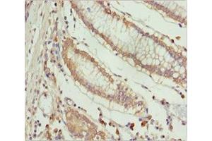 Immunohistochemistry of paraffin-embedded human colon cancer using ABIN7151996 at dilution of 1:100 (ERLIN2 anticorps  (AA 212-339))