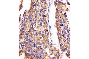 (ABIN6242389 and ABIN6578670) staining Hsp60 in human lung adenocarcinoma tissue sections by Immunohistochemistry (IHC-P - paraformaldehyde-fixed, paraffin-embedded sections).