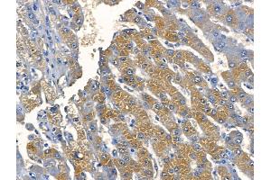 ABIN6259817 and ABIN6268680 at 1/100 staining Human liver cancer by IHC-P. (alpha Fetoprotein anticorps  (C-Term))