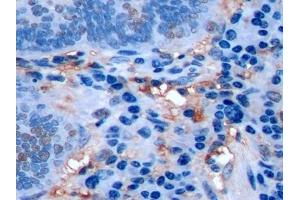 Detection of Ki-67 in Human Colorectal cancer Tissue using Polyclonal Antibody to Ki-67 Protein (Ki-67) (Ki-67 anticorps  (AA 3088-3235))