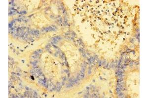 Immunohistochemistry of paraffin-embedded human endometrial cancer using ABIN7142407 at dilution of 1:100 (MRPL38 anticorps  (AA 35-380))