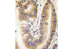 Formalin-fixed and paraffin-embedded human lung carcinoma tissue reacted with PTEN antibody (N-term) (ABIN6242545 and ABIN6579042) , which was peroxidase-conjugated to the secondary antibody, followed by DAB staining.