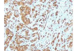 Formalin-fixed, paraffin-embedded human Melanoma stained with Melan-A / MART-1 Mouse Monoclonal Antibody (MLANA/788). (MLANA anticorps)