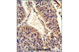 Formalin-fixed and paraffin-embedded human lung carcinoma reacted with ALG14 Antibody (Center), which was peroxidase-conjugated to the secondary antibody, followed by DAB staining. (ALG14 anticorps  (AA 67-93))