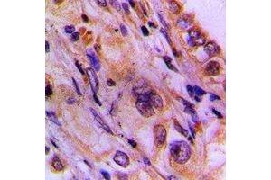 Immunohistochemical analysis of CEP78 staining in human lung cancer formalin fixed paraffin embedded tissue section. (CEP78 anticorps)