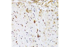 Immunohistochemistry of paraffin-embedded human rectal cancer using CDK4 Antibody.