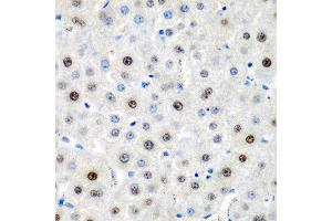Immunohistochemistry of paraffin-embedded human liver cancer using LMX1B antibody at dilution of 1:200 (40x lens).