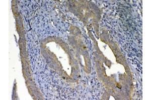 IHC testing of FFPE human rectal cancer tissue with UGT1A1 antibody at 1ug/ml. (UGT1A1 anticorps)