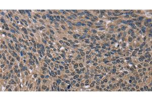 Immunohistochemistry of paraffin-embedded Human lung cancer using IMPDH2 Polyclonal Antibody at dilution of 1:60 (IMPDH2 anticorps)