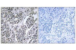 Immunohistochemistry analysis of paraffin-embedded human lung carcinoma tissue using ATP5D antibody. (ATP5F1D anticorps  (Internal Region))