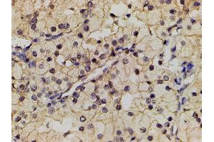ABIN6267452 at 1/200 staining human renal clear cell carcinoma tissue sections by IHC-P.