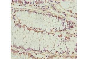 Immunohistochemistry of paraffin-embedded human colon cancer using ABIN7157472 at dilution of 1:100 (KERA anticorps  (AA 21-352))