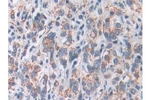 Detection of SOD2 in Human Prostate cancer Tissue using Polyclonal Antibody to Superoxide Dismutase 2, Mitochondrial (SOD2) (SOD2 anticorps  (AA 25-222))