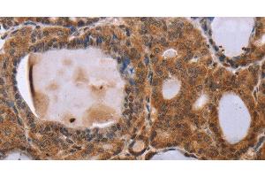 Immunohistochemistry of paraffin-embedded Human thyroid cancer using NDUFA2 Polyclonal Antibody at dilution of 1:30 (NDUFA2 anticorps)