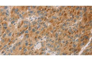 Immunohistochemistry of paraffin-embedded Human liver cancer tissue using CYP11B1 Polyclonal Antibody at dilution 1:30 (CYP11B1 anticorps)