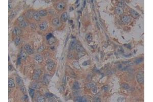 Detection of CD40 in Human Breast cancer Tissue using Polyclonal Antibody to Tumor Necrosis Factor Receptor Superfamily, Member 5 (CD40)