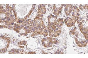 ABIN6279468 at 1/100 staining Human liver cancer tissue by IHC-P. (GNG12 anticorps)