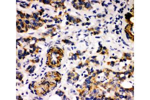 Anti-Human Milk Fat Globule 1 antibody, IHC(P) IHC(P): Human Mammary Cancer Tissue (MFGE8 anticorps  (Middle Region))